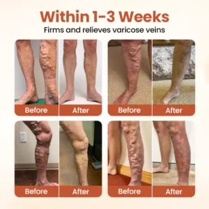 ODALIT™ VeinTarget Microneedle Patch
