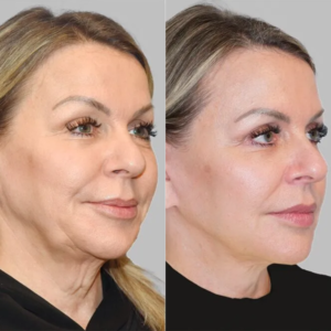 Bellavren™ | Visibly reduces wrinkles by up to 98% in just 17 minutes