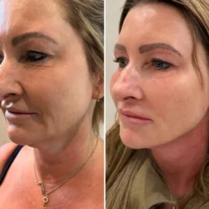 Bellavren™ | Visibly reduces wrinkles by up to 98% in just 17 minutes