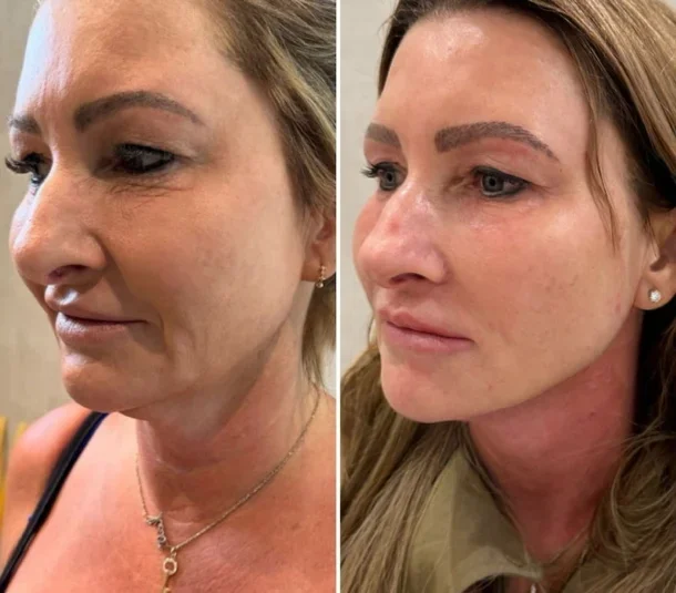 Bellavren™ | Visibly reduces wrinkles by up to 98% in just 17 minutes