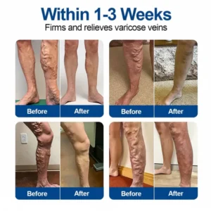GFOUK® VeinEase Microneedle Care Patch