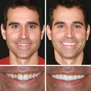 Yagoo™ Advanced Denture Kit Elevate Kit