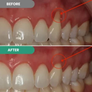 Cureend Teeth Repair Gel