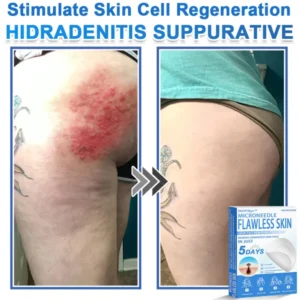 SkinPrikyn™ 2-in-1 Microneedle & Hydrocolloid Patch