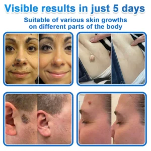 Celsiora® 2-in-1 Microneedle & Hydrocolloid Patch