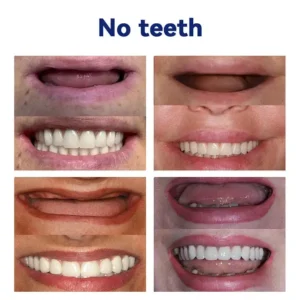 NESLEMY™- Advanced Customized Full Denture Set